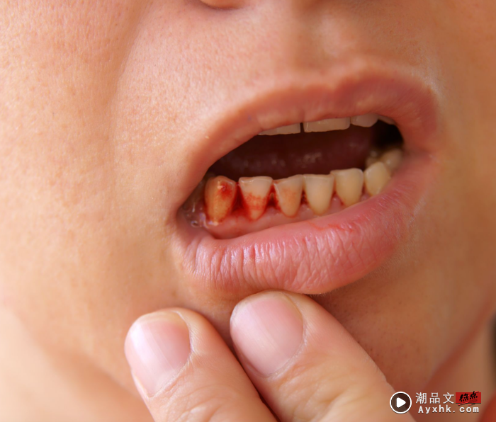 Tips｜牙龈突然出血要小心，除了牙周病还可能是肝生病！ 更多热点 图1张